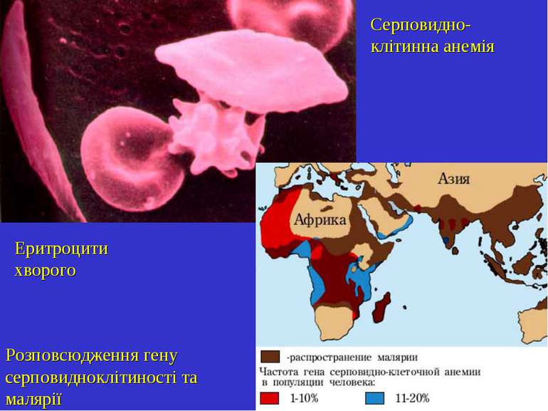Серповидно-клітинна анемія Еритроцити хворого Розповсюдження гену серповиднок...