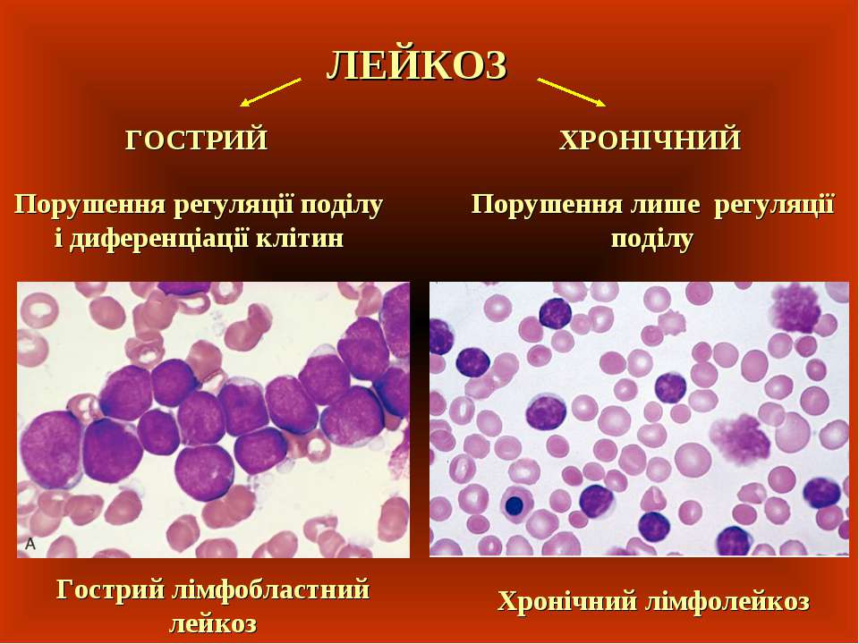 Лейкоз характеризуется. Острый лейкоз с лейкопенией. Тромбо бластный лейкоз. Лейкемический лейкоцитоз.