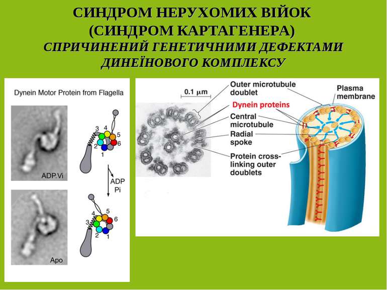 СИНДРОМ НЕРУХОМИХ ВІЙОК (СИНДРОМ КАРТАГЕНЕРА) СПРИЧИНЕНИЙ ГЕНЕТИЧНИМИ ДЕФЕКТА...