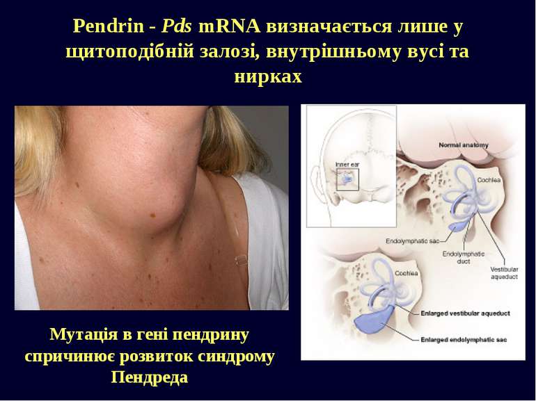 Pendrin - Pds mRNA визначається лише у щитоподібній залозі, внутрішньому вусі...
