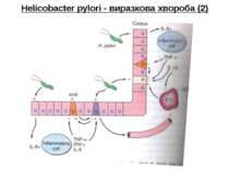 Helicobacter pylori - виразкова хвороба (2)