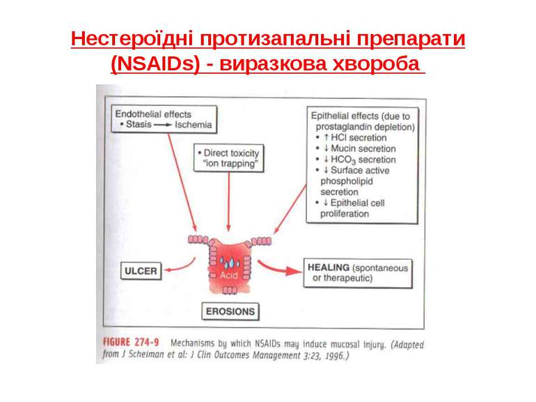 Нестероїдні протизапальні препарати (NSAIDs) - виразкова хвороба