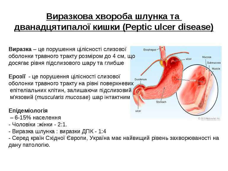 Виразкова хвороба шлунка та дванадцятипалої кишки (Peptic ulcer disease) Вира...