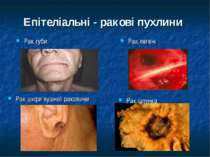 Епітеліальні - ракові пухлини Рак губи Рак легені Рак шкіри вушної раковини Р...