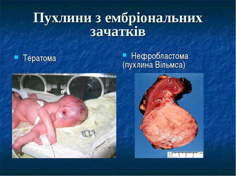 Пухлини з ембріональних зачатків Тератома Нефробластома (пухлина Вільмса)