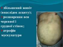 збільшений живіт (внаслідок асциту); розширення вен черевної і грудної стінок...