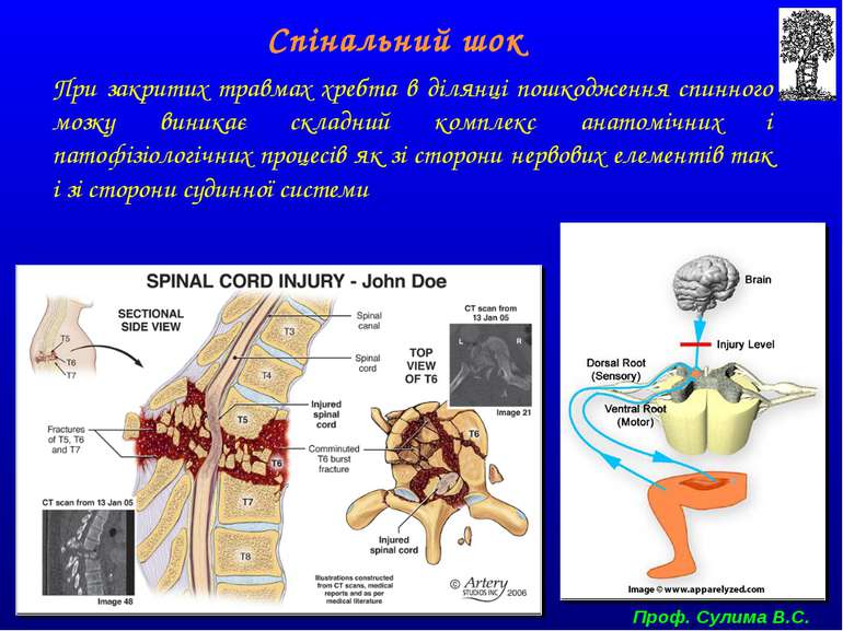 При закритих травмах хребта в ділянці пошкодження спинного мозку виникає скла...