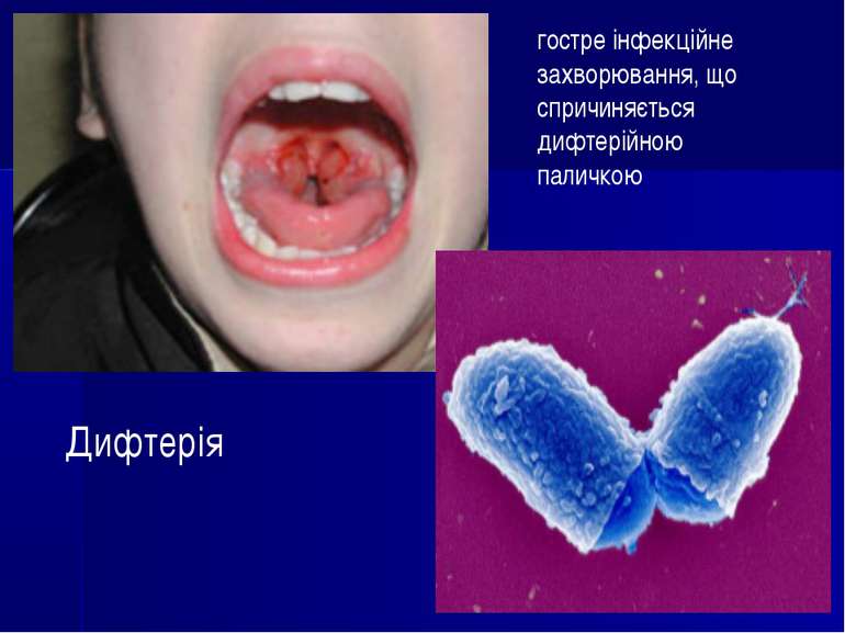 Дифтерія гостре інфекційне захворювання, що спричиняється дифтерійною паличкою