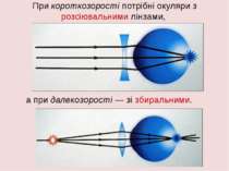 При короткозорості потрібні окуляри з розсіювальними лінзами, а при далекозор...