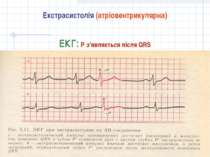 Екстрасистолія (атріовентрикулярна) ЕКГ: Р з’являється після QRS