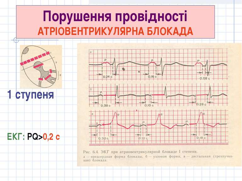 Реферат: Порушення серцевого ритму і провідності у дитячому віці