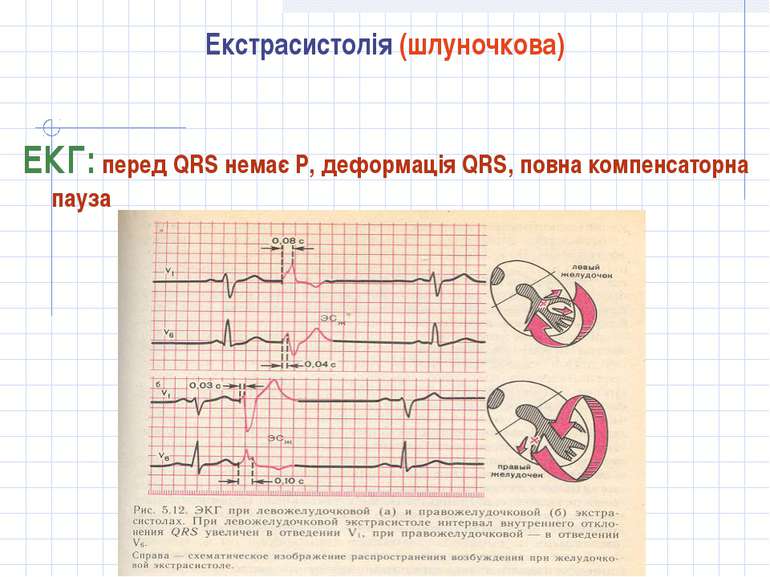 Екстрасистолія (шлуночкова) ЕКГ: перед QRS немає Р, деформація QRS, повна ком...