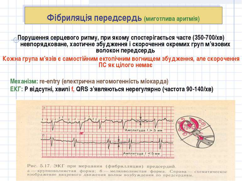 Фібриляція передсердь (миготлива аритмія) Порушення серцевого ритму, при яком...