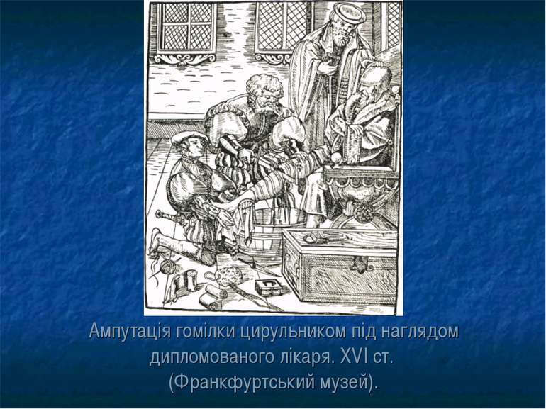 Ампутація гомілки цирульником під наглядом дипломованого лікаря. XVI ст. (Фра...