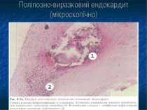 Поліпозно-виразковий ендокардит (мікроскопічно)