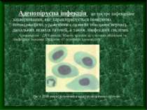 Аденовірусна інфекція – це гостре інфекційне захворювання, яке характеризуєть...