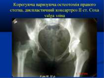 Корегуюча варизуюча остеотомія правого стегна, диспластичний коксартроз ІІ ст...