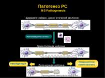 Патогенез РС MS Pathogenesis