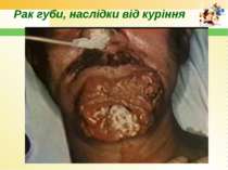 Рак губи, наслідки від куріння