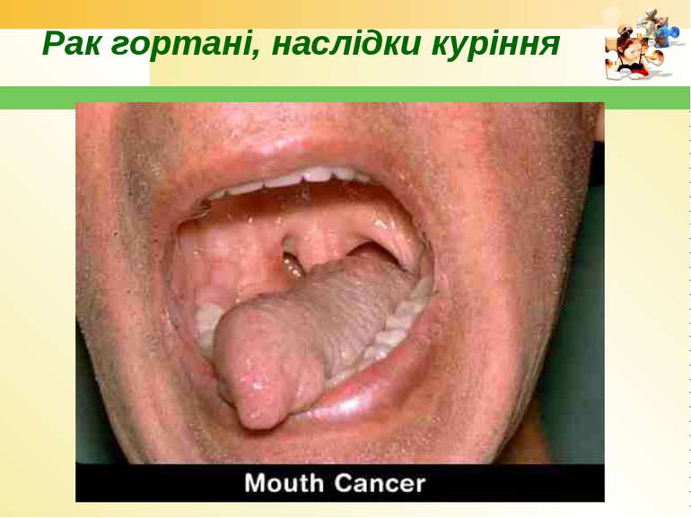 Рак гортані, наслідки куріння