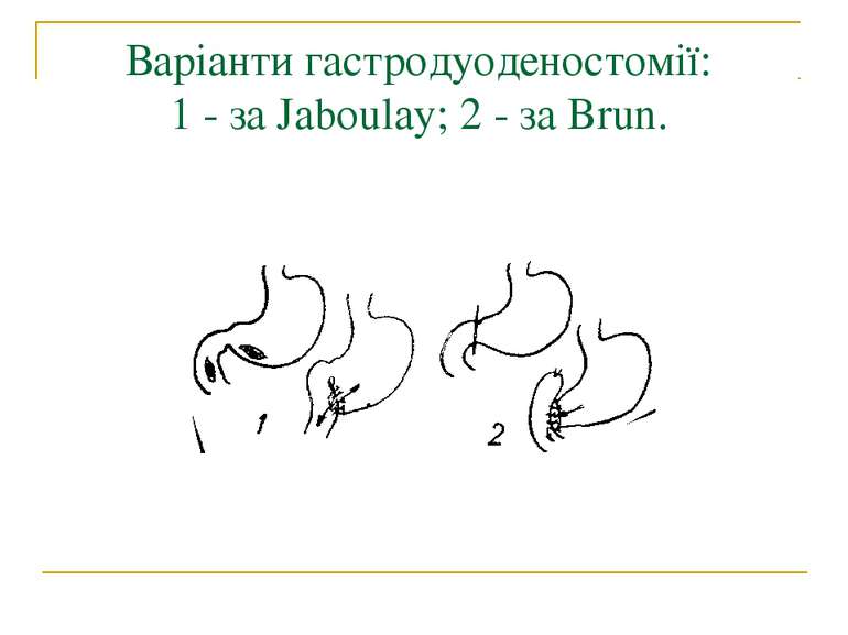 Варіанти гастродуоденостомії: 1 - за Jaboulay; 2 - за Brun.