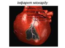 Інфаркт міокарду