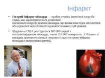 Інфаркт Гострий інфаркт міокарда — крайня ступінь ішемічної хвороби серця, як...