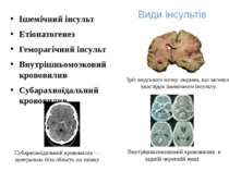 Види інсультів Ішемічний інсульт Етіопатогенез Геморагічний інсульт Внутрішнь...