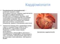 Кардіоміопатія Кардіоміопатія (міокардіопатія) — ураження серцевого м'язу нез...
