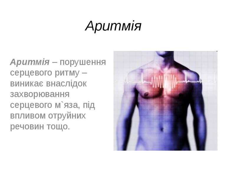 Аритмія Аритмія – порушення серцевого ритму – виникає внаслідок захворювання ...