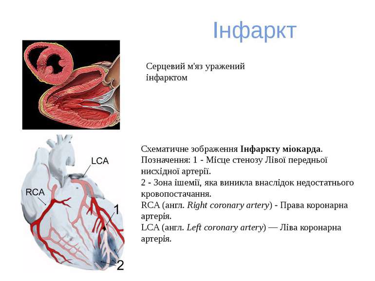 Інфаркт Схематичне зображення Інфаркту міокарда. Позначення: 1 - Місце стеноз...