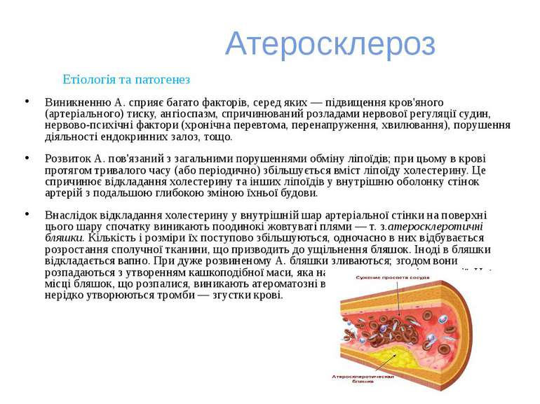 Атеросклероз Етіологія та патогенез Виникненню А. сприяє багато факторів, сер...