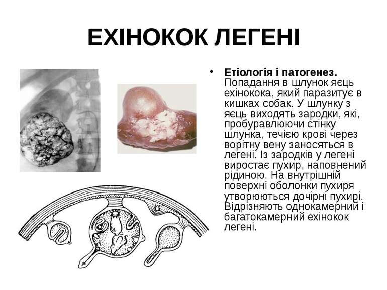 ЕХІНОКОК ЛЕГЕНІ Етіологія і патогенез. Попадання в шлунок яєць ехінокока, яки...