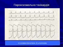 Пароксизмальна тахікардія а) суправентрикулярна; б) шлуночкова