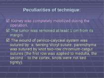 Peculiarities of technique: Kidney was completely mobilized during the operat...