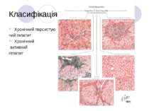 Класифікація Хронічний персистую чий гепатит Хронічний активний гепатит
