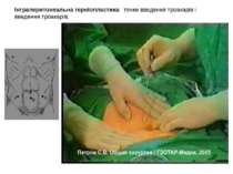 Інтраперитонеальна герніопластика: точки введення троакарів і введення троака...