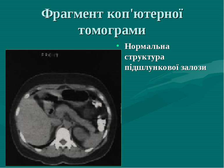Фрагмент коп'ютерної томограми Нормальна структура пiдшлункової залози