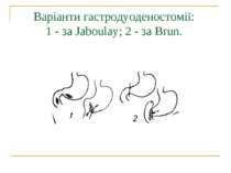 Варіанти гастродуоденостомії: 1 - за Jaboulay; 2 - за Brun.