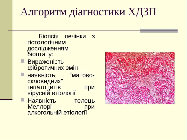 Алгоритм діагностики ХДЗП Біопсія печінки з гістологічним дослідженням біопта...