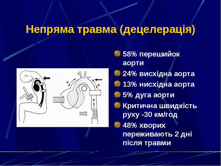 Непряма травма (децелерація) 58% перешийок аорти 24% висхідна аорта 13% нисхі...