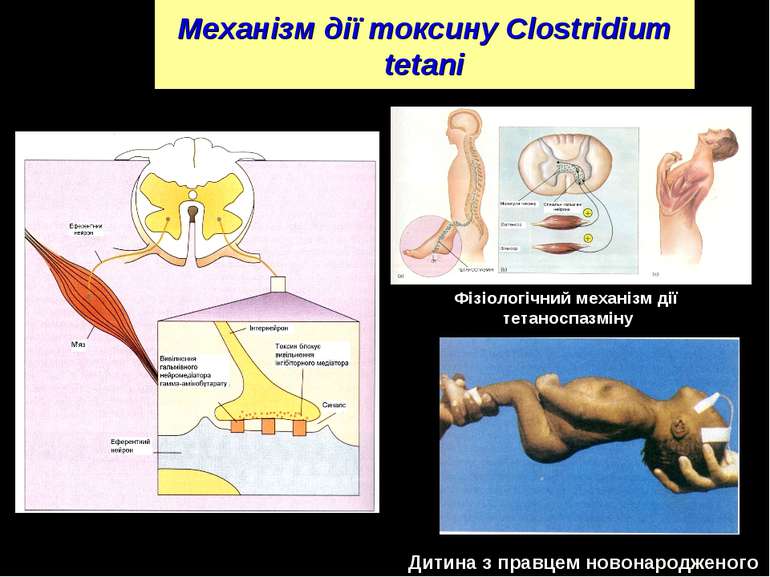 Механізм дії токсину Clostridium tetani Фізіологічний механізм дії тетаноспаз...