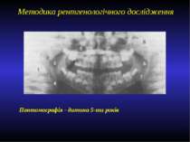 Методика рентгенологічного дослідження Пантомографія - дитина 5-ти років