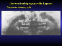 Патологічні процеси зубів і щелеп Порушення розвитку зубів