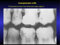 Захворювання зубів Рентгенологічне дослідження при карієсі