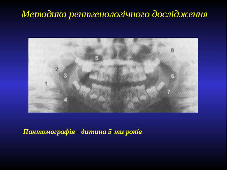 Методика рентгенологічного дослідження Пантомографія - дитина 5-ти років