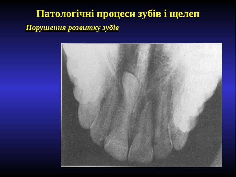 Патологічні процеси зубів і щелеп Порушення розвитку зубів