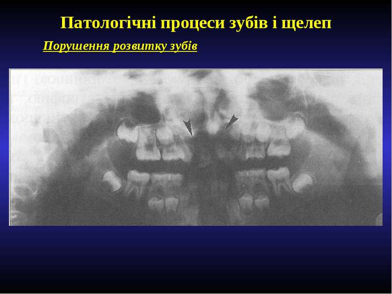 Патологічні процеси зубів і щелеп Порушення розвитку зубів