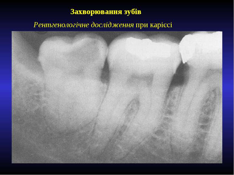 Захворювання зубів Рентгенологічне дослідження при карієсі