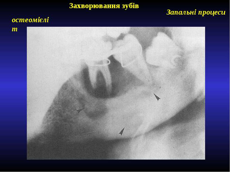 Захворювання зубів Запальні процеси остеомієліт